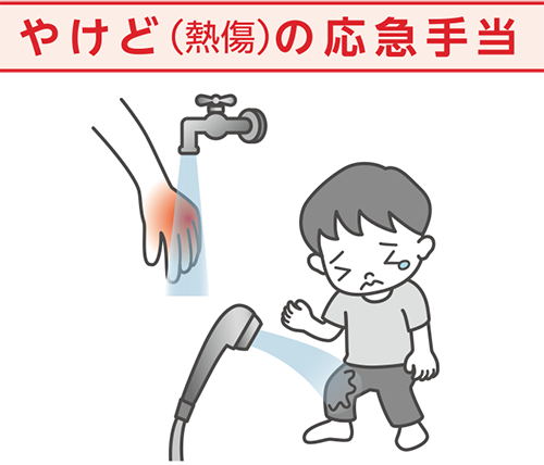 やけど（熱傷）の応急手当